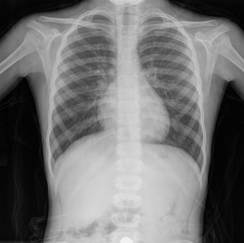 chest-x-ray
